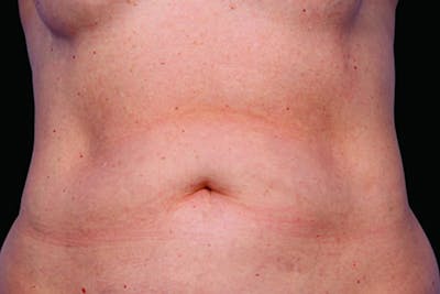 Coolsculpting Body Fat Reduction Before & After Gallery - Patient 214288 - Image 1