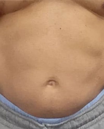PCDC Lipodissolve Before & After Gallery - Patient 319168 - Image 2