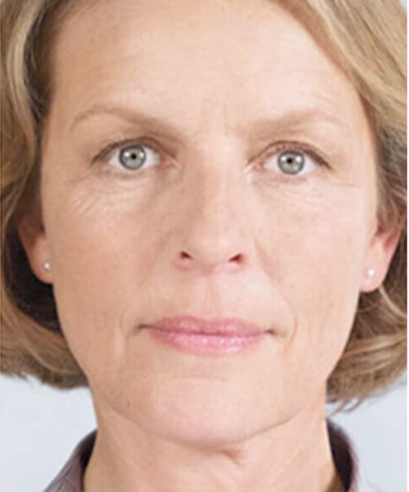 Liquid Mini Facelift and Anti-Aging Before & After Gallery - Patient 323274 - Image 2