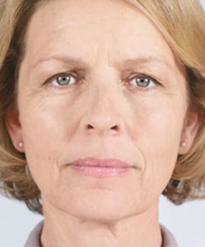 Liquid Mini Facelift and Anti-Aging Before & After Gallery - Patient 323274 - Image 1