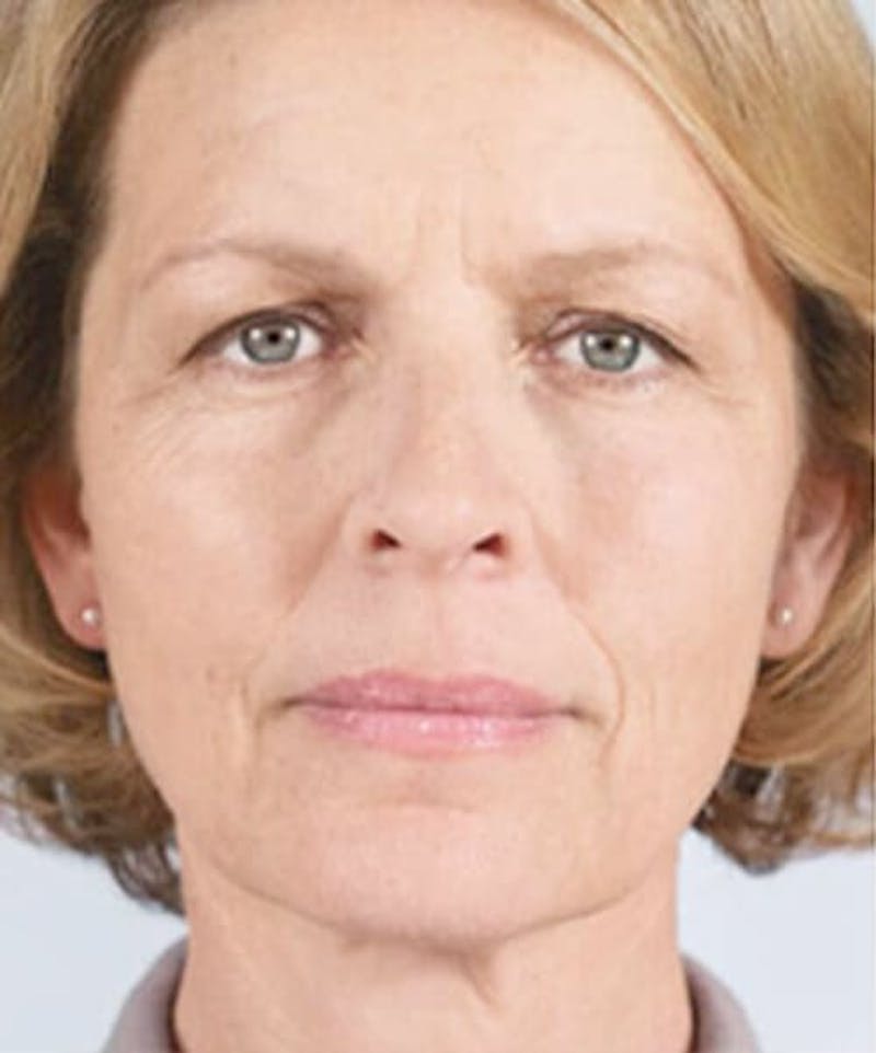 Liquid Mini Facelift and Anti-Aging Before & After Gallery - Patient 323274 - Image 1