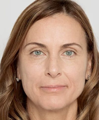 Liquid Mini Facelift and Anti-Aging Before & After Gallery - Patient 416474 - Image 2