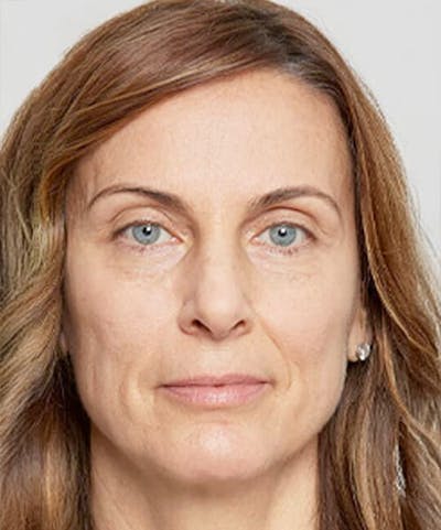 Liquid Mini Facelift and Anti-Aging Before & After Gallery - Patient 416474 - Image 1