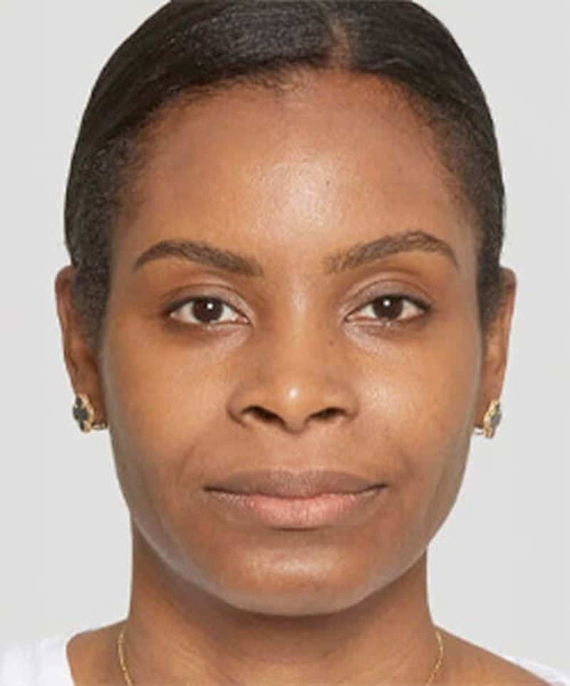 Liquid Mini Facelift and Anti-Aging Before & After Gallery - Patient 201402 - Image 2