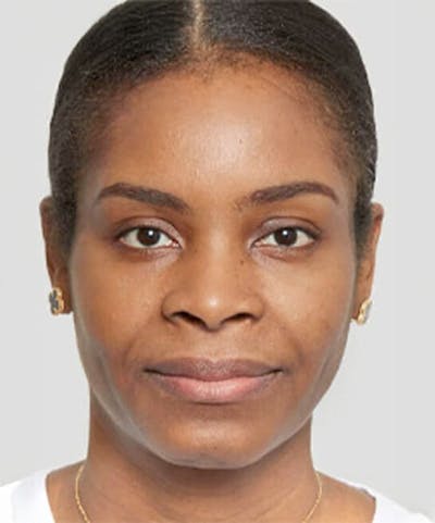 Liquid Mini Facelift and Anti-Aging Before & After Gallery - Patient 201402 - Image 1