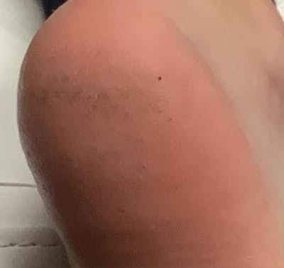 Plantar Wart Removal Before & After Gallery - Patient 165078 - Image 2