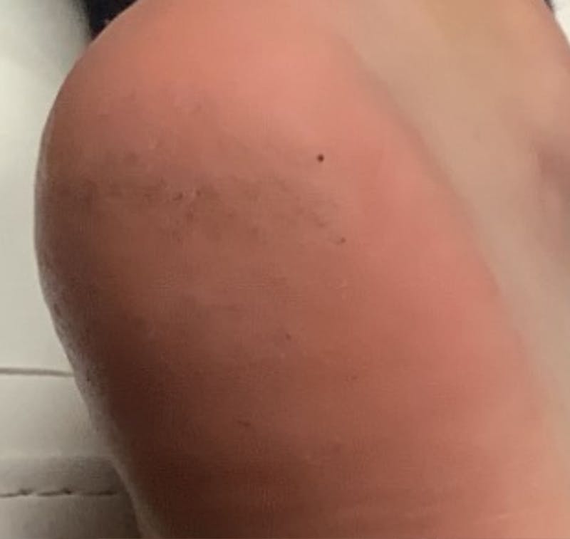 Plantar Wart Removal Before & After Gallery - Patient 165078 - Image 2