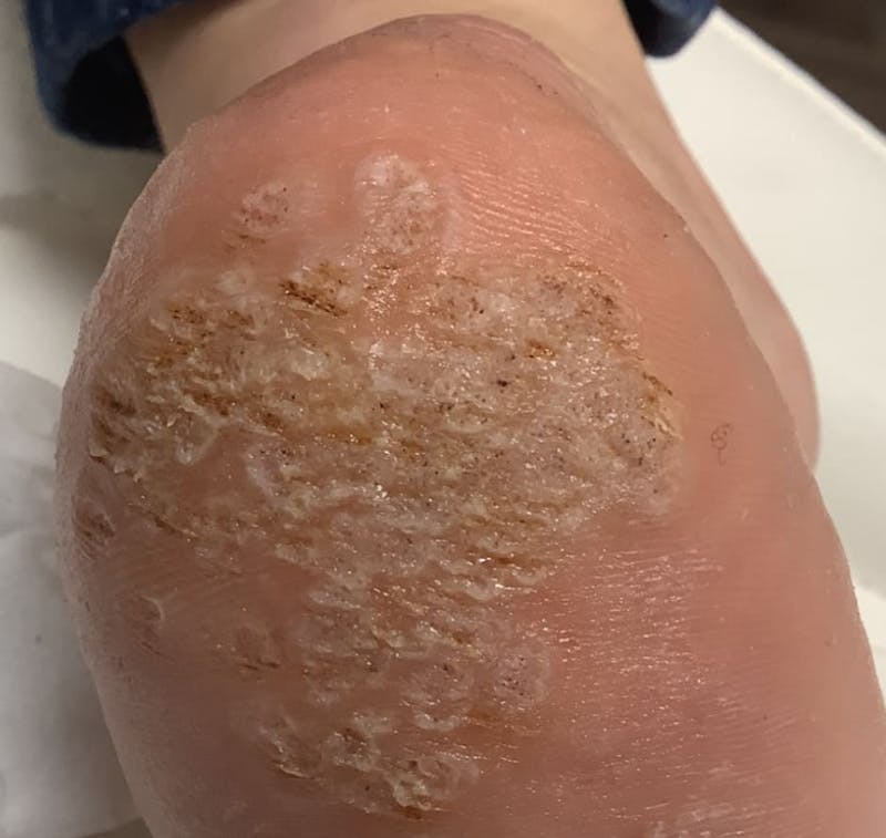 Plantar Wart Removal Before & After Gallery - Patient 165078 - Image 1