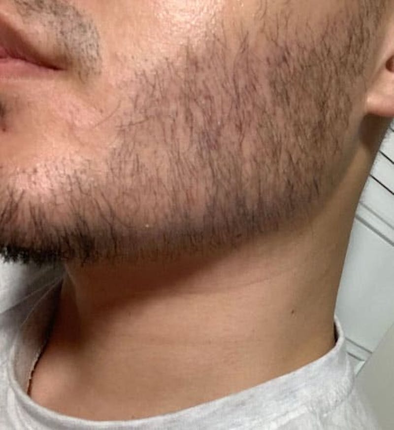 Beard Transplant Before & After Gallery - Patient 272147 - Image 2
