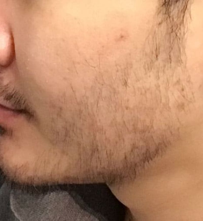 Beard Transplant Before & After Gallery - Patient 272147 - Image 1