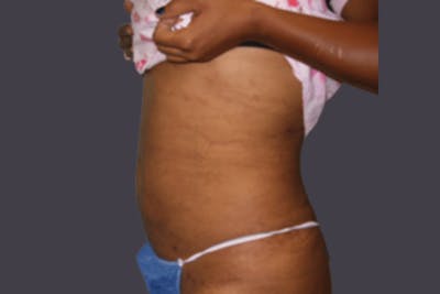 Smartlipo Before & After Gallery - Patient 284847 - Image 2
