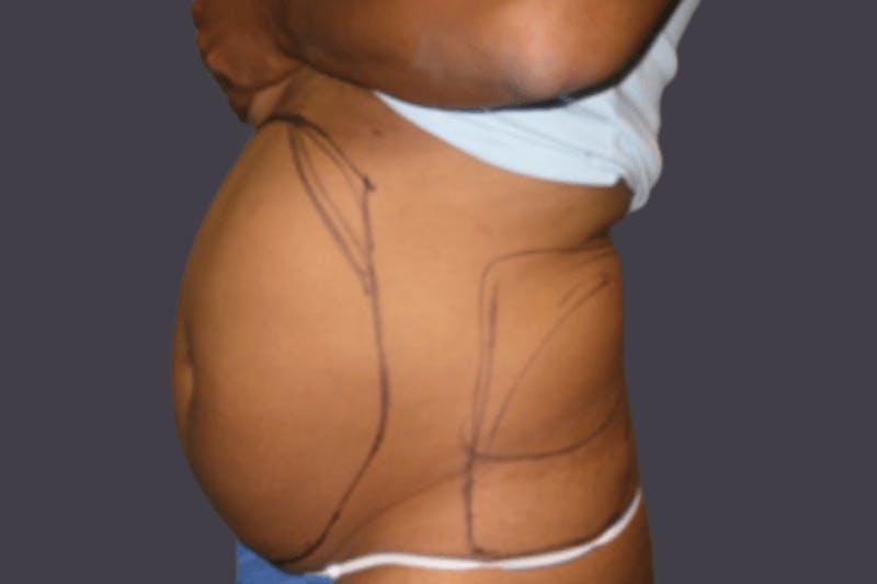 Smartlipo Before & After Gallery - Patient 284847 - Image 1