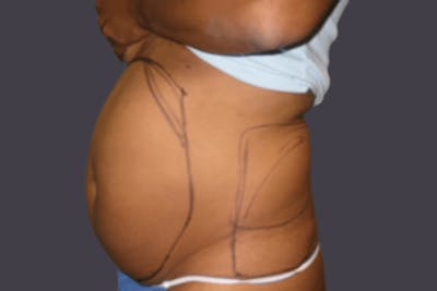 Smartlipo Before & After Gallery - Patient 284847 - Image 1