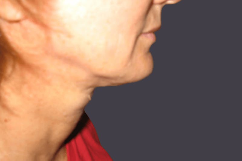 Smartlipo Before & After Gallery - Patient 184286 - Image 2
