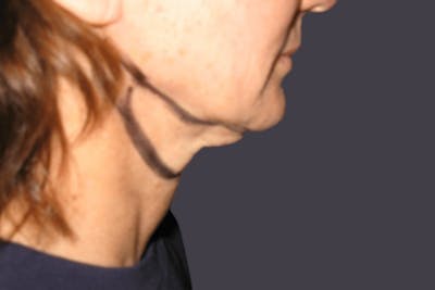 Smartlipo Before & After Gallery - Patient 184286 - Image 1