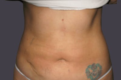 Smartlipo Before & After Gallery - Patient 526540 - Image 2
