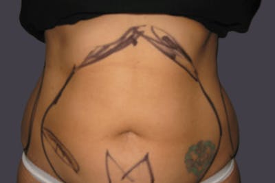 Smartlipo Before & After Gallery - Patient 526540 - Image 1