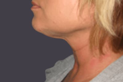 Smartlipo Before & After Gallery - Patient 378854 - Image 2