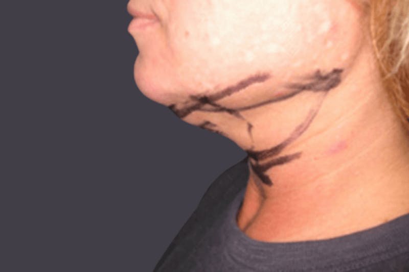 Smartlipo Before & After Gallery - Patient 378854 - Image 1