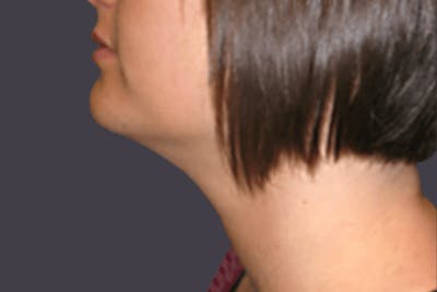 Smartlipo Before & After Gallery - Patient 128543 - Image 2