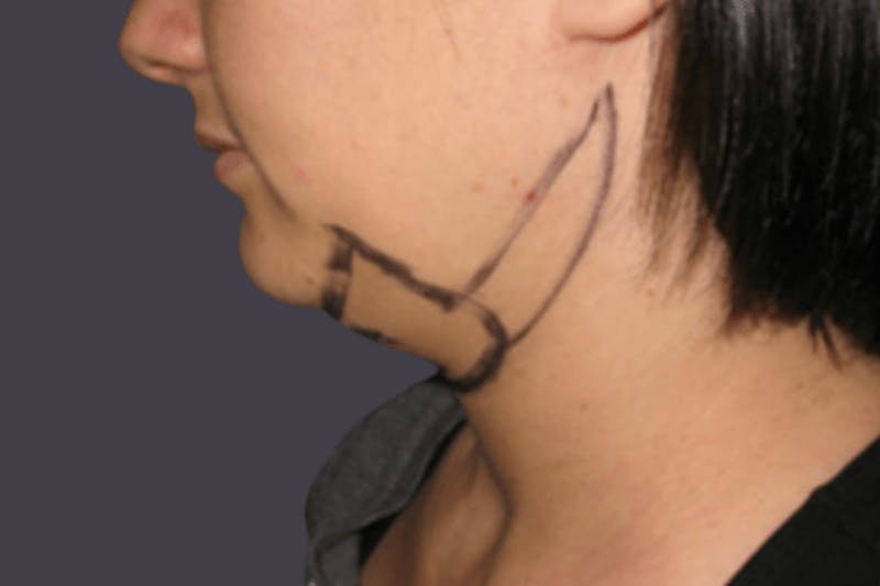 Smartlipo Before & After Gallery - Patient 128543 - Image 1