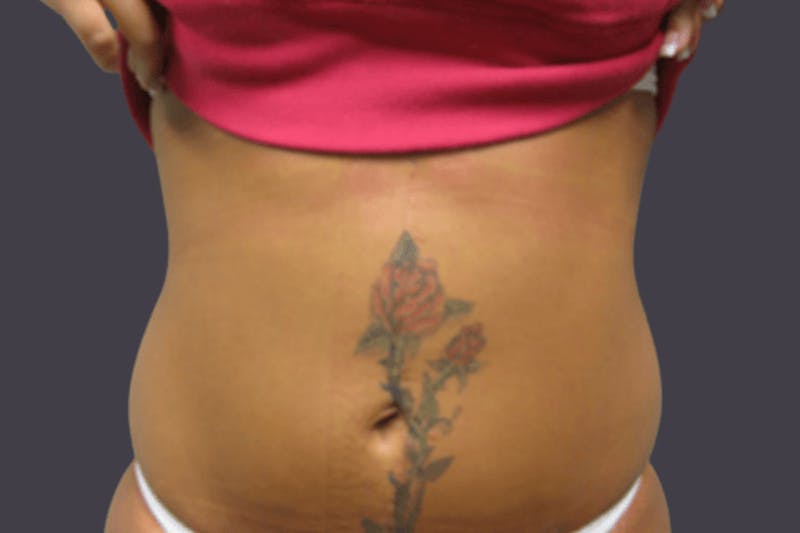 Smartlipo Before & After Gallery - Patient 153060 - Image 2