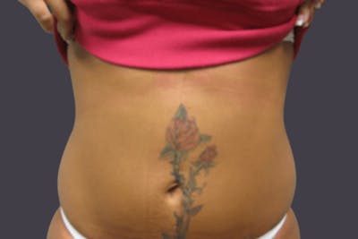 Smartlipo Before & After Gallery - Patient 153060 - Image 2