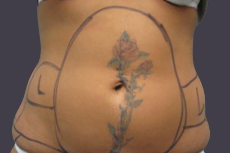 Smartlipo Before & After Gallery - Patient 153060 - Image 1