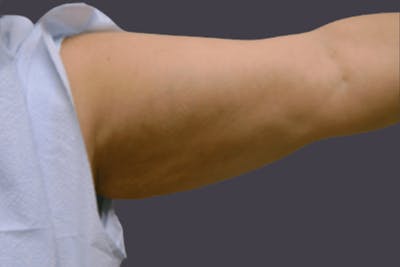 Smartlipo Before & After Gallery - Patient 259415 - Image 2