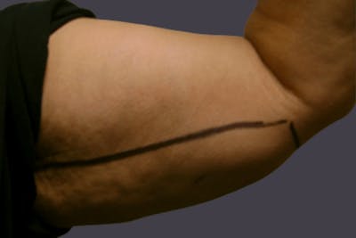 Smartlipo Before & After Gallery - Patient 259415 - Image 1