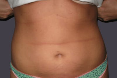 Smartlipo Before & After Gallery - Patient 618052 - Image 2