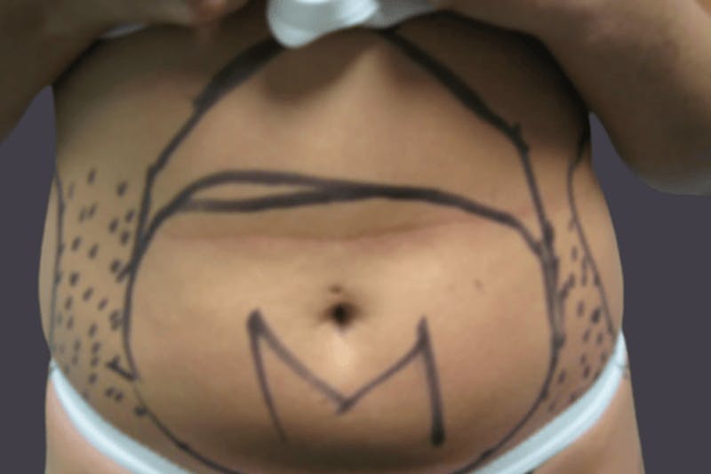 Smartlipo Before & After Gallery - Patient 618052 - Image 1