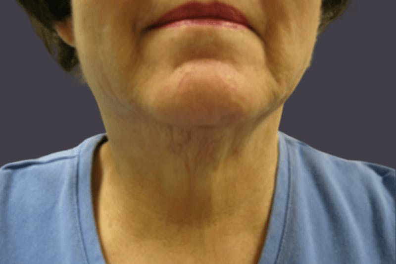 Smartlipo Before & After Gallery - Patient 373734 - Image 2