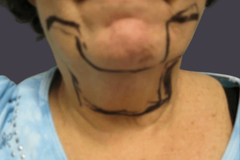 Smartlipo Before & After Gallery - Patient 373734 - Image 1