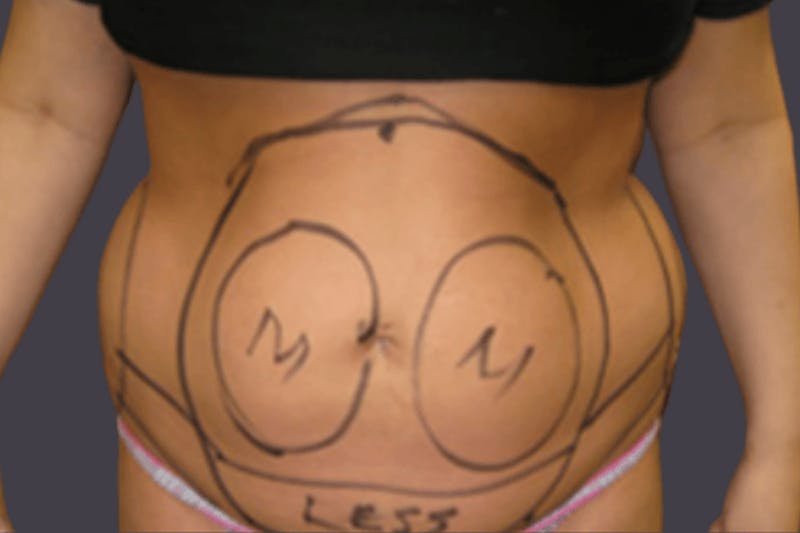 Smartlipo Before & After Gallery - Patient 114570 - Image 1
