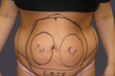 Smartlipo Before & After Gallery - Patient 114570 - Image 1