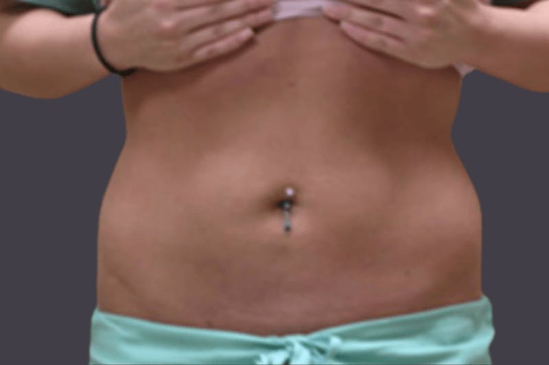 Smartlipo Before & After Gallery - Patient 114570 - Image 2