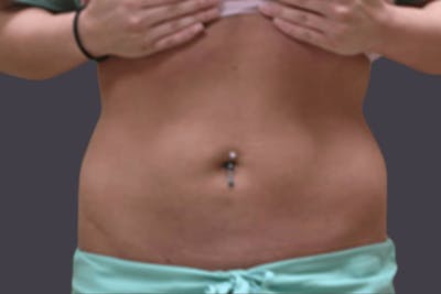Smartlipo Before & After Gallery - Patient 114570 - Image 2