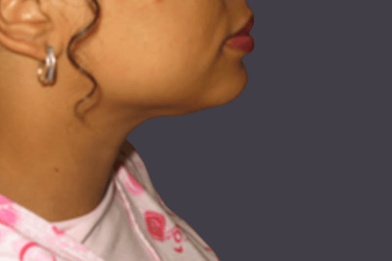 Smartlipo Before & After Gallery - Patient 112183 - Image 2