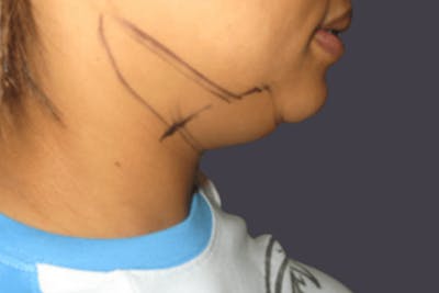 Smartlipo Before & After Gallery - Patient 112183 - Image 1