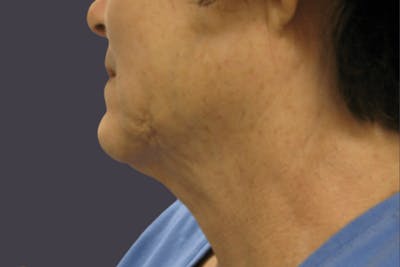Smartlipo Before & After Gallery - Patient 275330 - Image 2