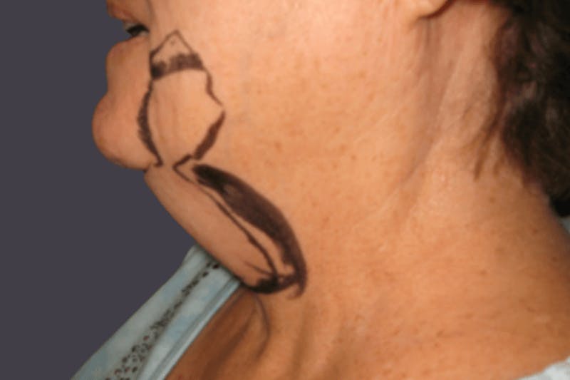 Smartlipo Before & After Gallery - Patient 275330 - Image 1