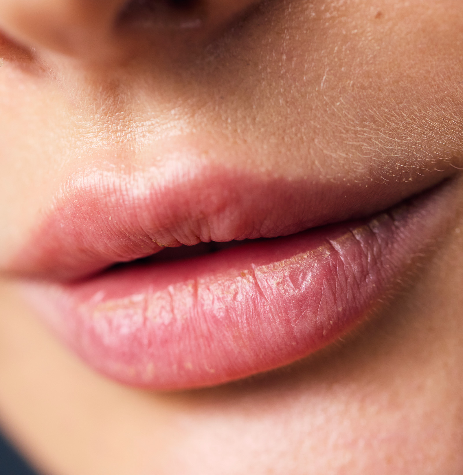 Lip Fillers in Midtown NYC | StudioMD