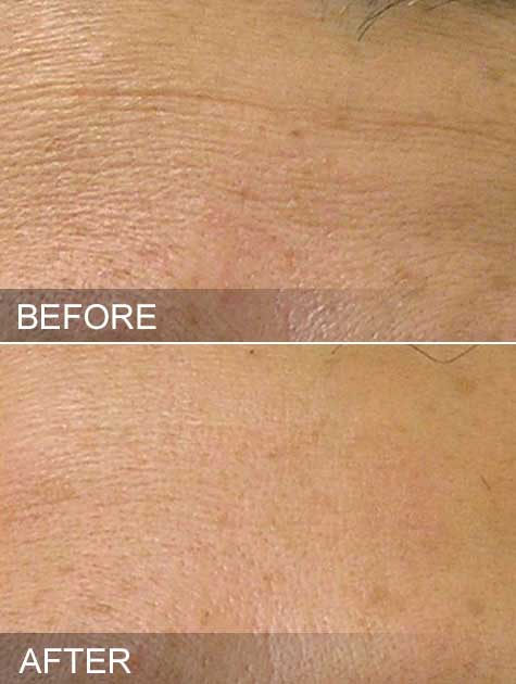 hydrafacial results