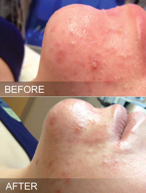 hydrafacial results