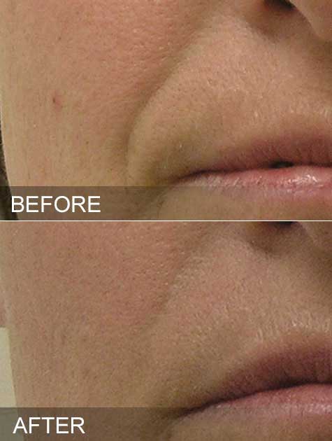 hydrafacial results