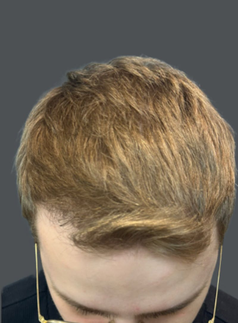 Hair Transplant Before & After Gallery - Patient 223066 - Image 1