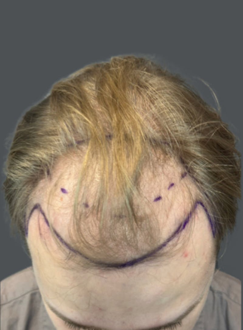Hair Transplant Before & After Gallery - Patient 223066 - Image 2