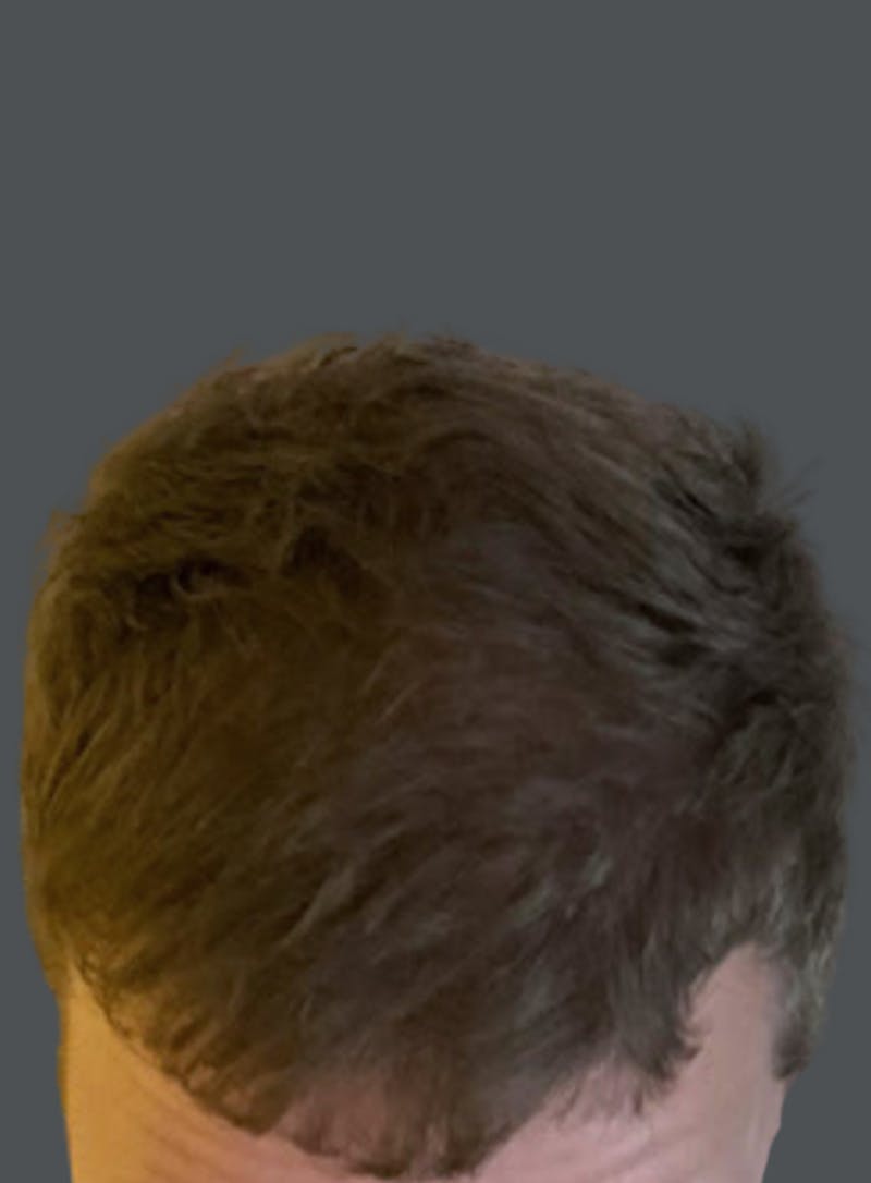 Hair Transplant Before & After Gallery - Patient 278621 - Image 2