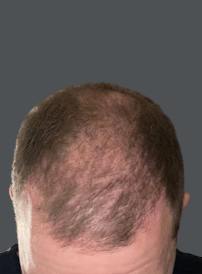 Hair Transplant Before & After Gallery - Patient 278621 - Image 1
